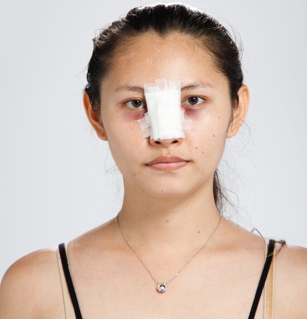 Reconstructive rhinoplasty procedure infographic