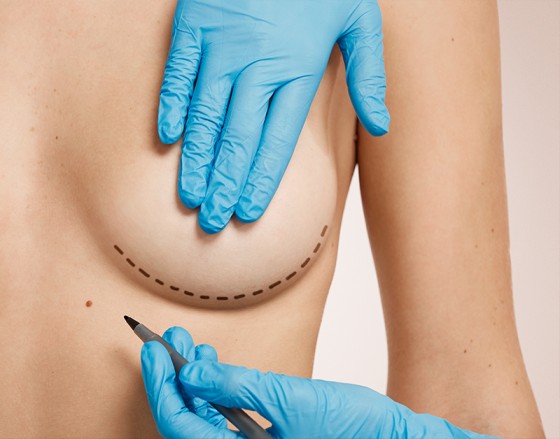 Breast Augmentation: Enhancing Size and Shape