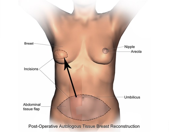 Autologous (Flap) Reconstruction